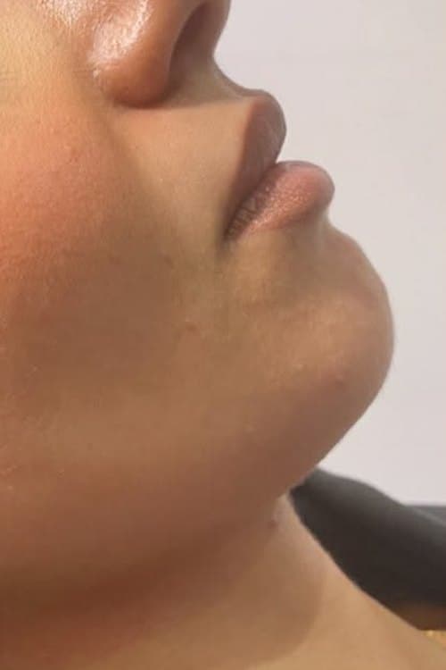 Perfil con el mentón y la mandíbula antes y después de la armonización facial: antes