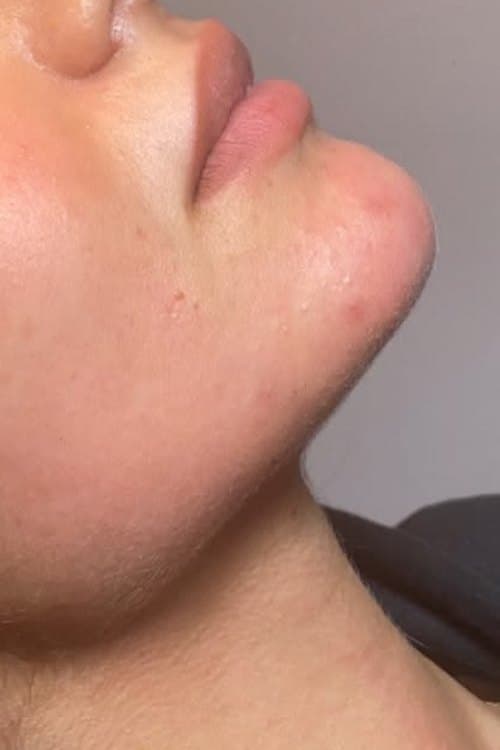 Perfil con el mentón y la mandíbula antes y después de la armonización facial: después