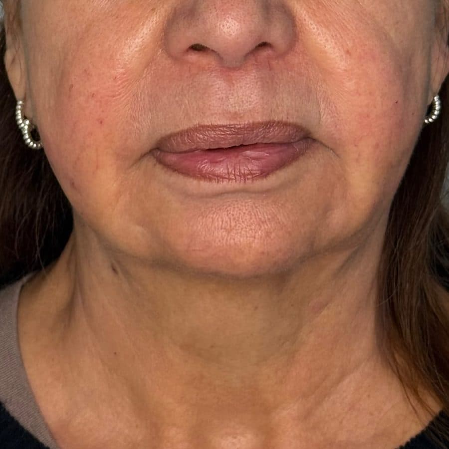 Rostro y cuello antes y después de Cellbooster Shape, caso 3: antes