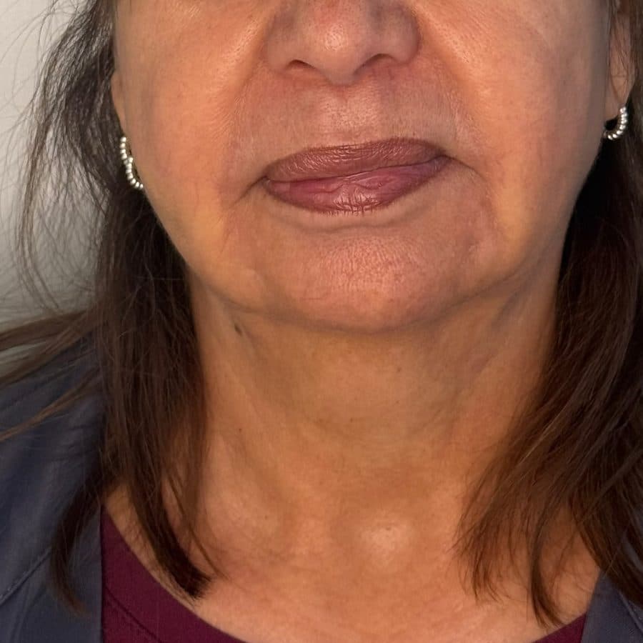 Rostro y cuello antes y después de Cellbooster Shape, caso 3: después