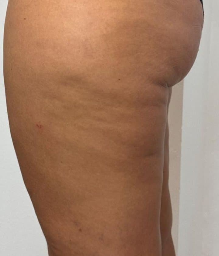Muslo con celulitis antes y después de la mesoterapia corporal: antes