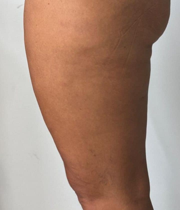 Muslo con celulitis antes y después de la mesoterapia corporal: después