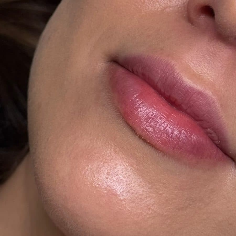Labios antes y después del relleno, caso 1: antes