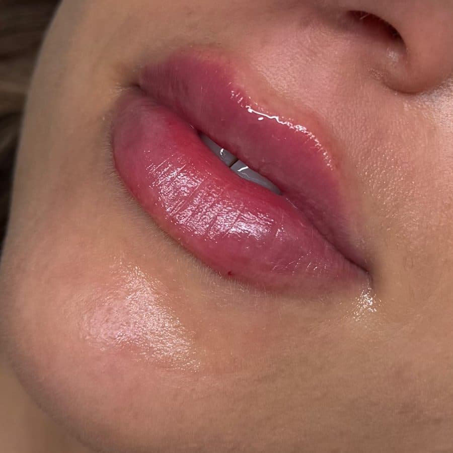 Labios antes y después del relleno, caso 1: después