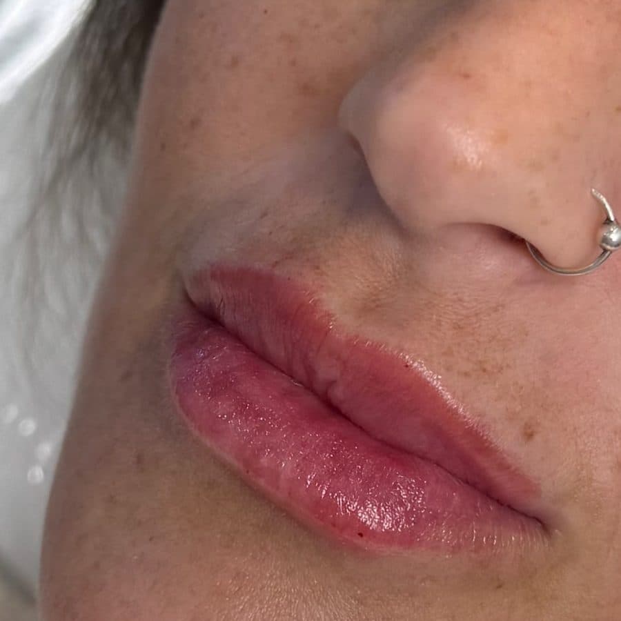 Labios antes y después del relleno, caso 3: después