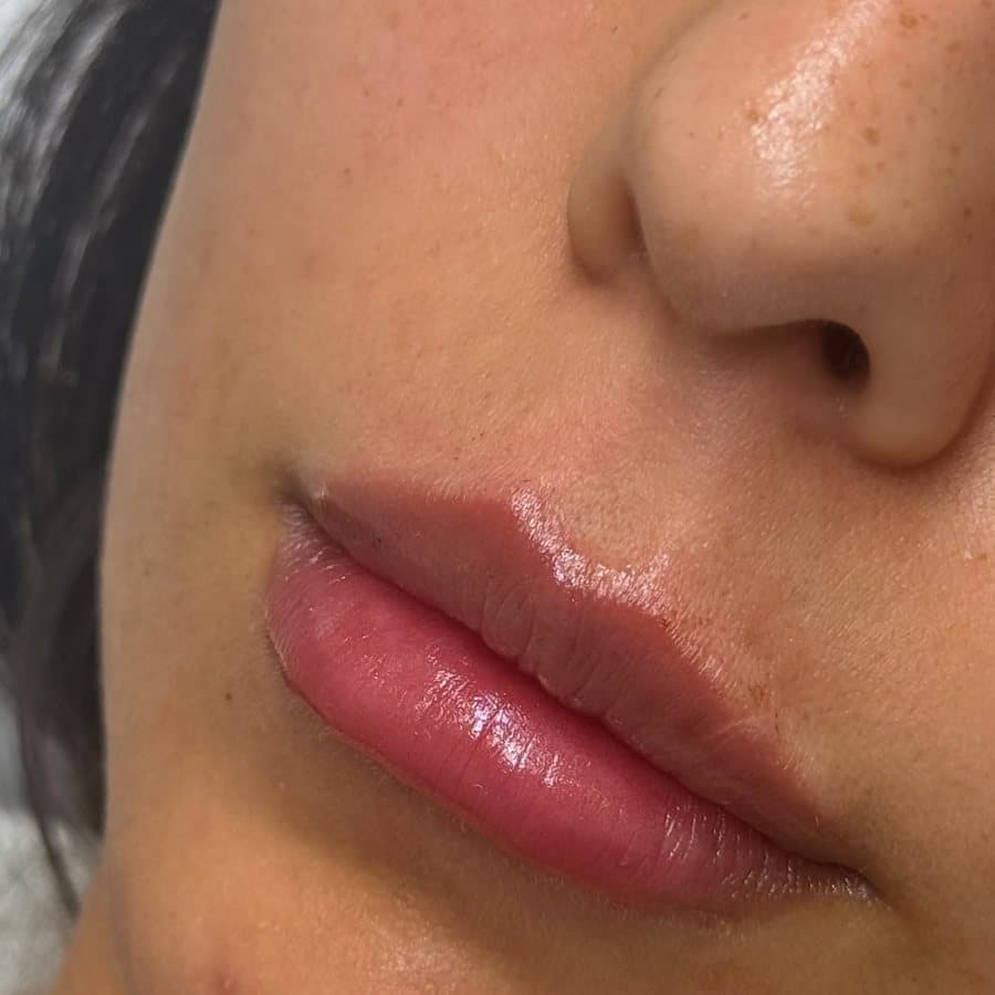 Labios antes y después del relleno, caso 4: después