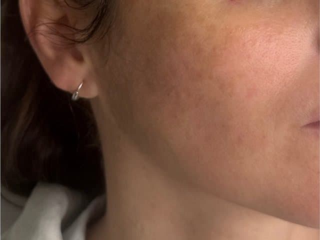 Mejilla con manchas antes y después de Mesopeel: después