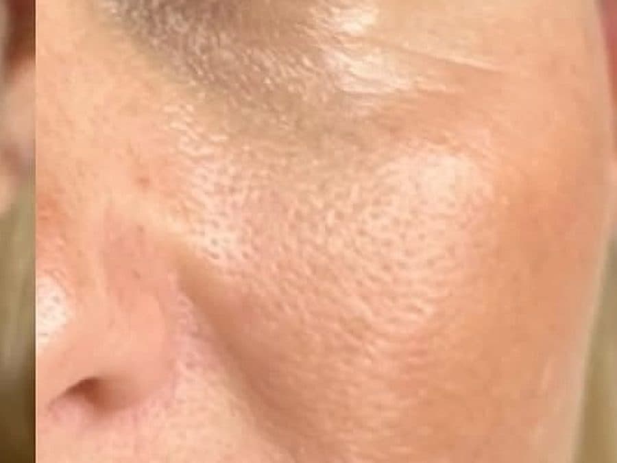 Zona bajo el ojo antes y después de la Mesoterapia NCTF para ojeras: después