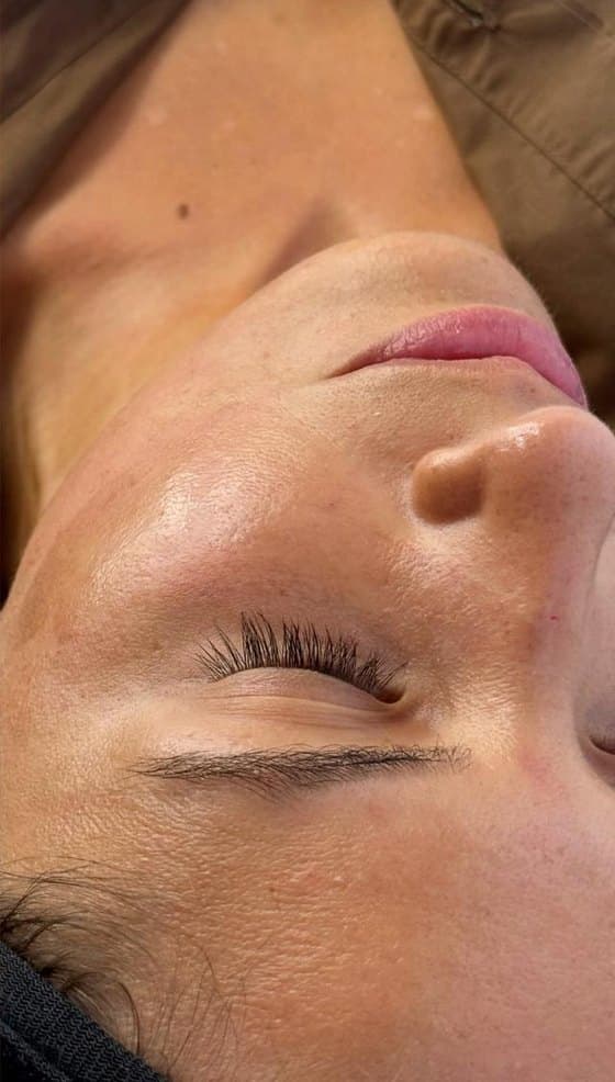 Rostro antes y después del plasma rico en plaquetas facial: después