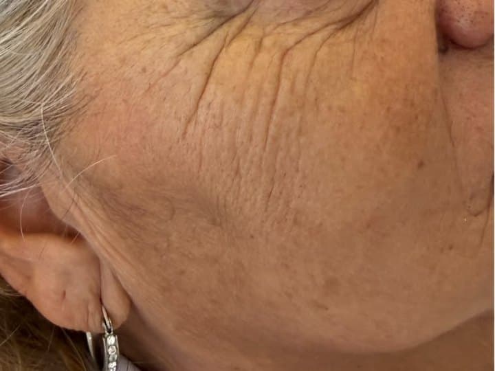 Piel del contorno del ojo antes y después del Skinbooster: antes