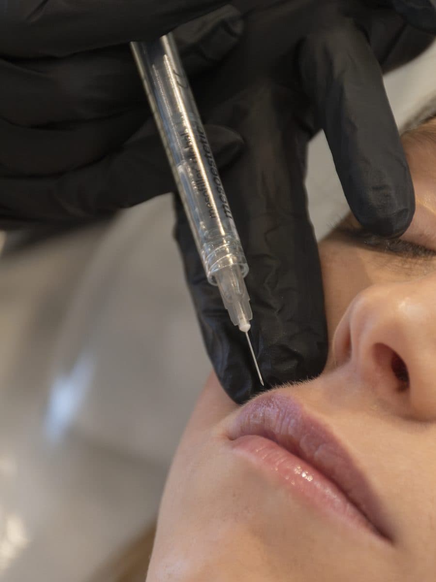 Aplicación de relleno en los labios
